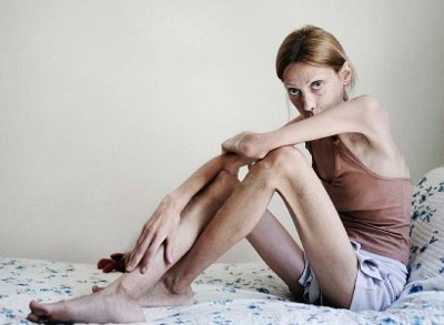 anoressia(1)