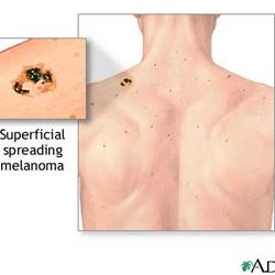 MELANOMA